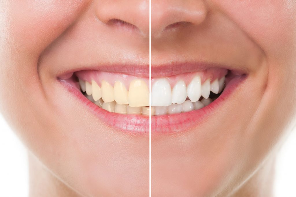 How Much Does Teeth Whitening Cost in the Boston Area?